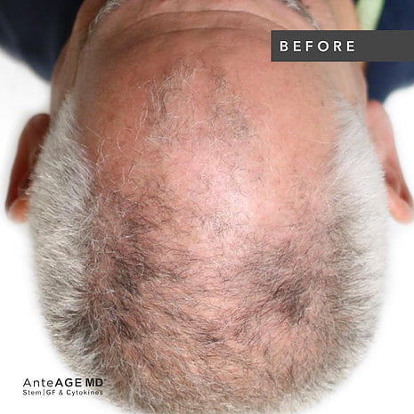 AnteAGE® Hair Restoration Solution