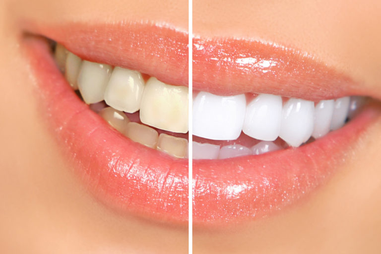 teeth whitening