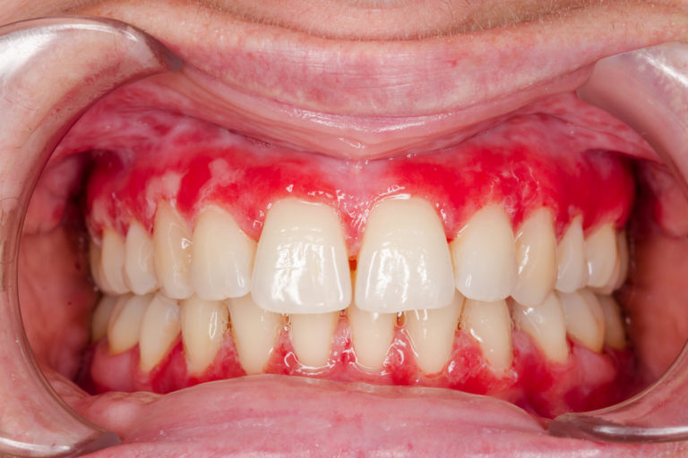 What are the best ways to minimize a gummy smile