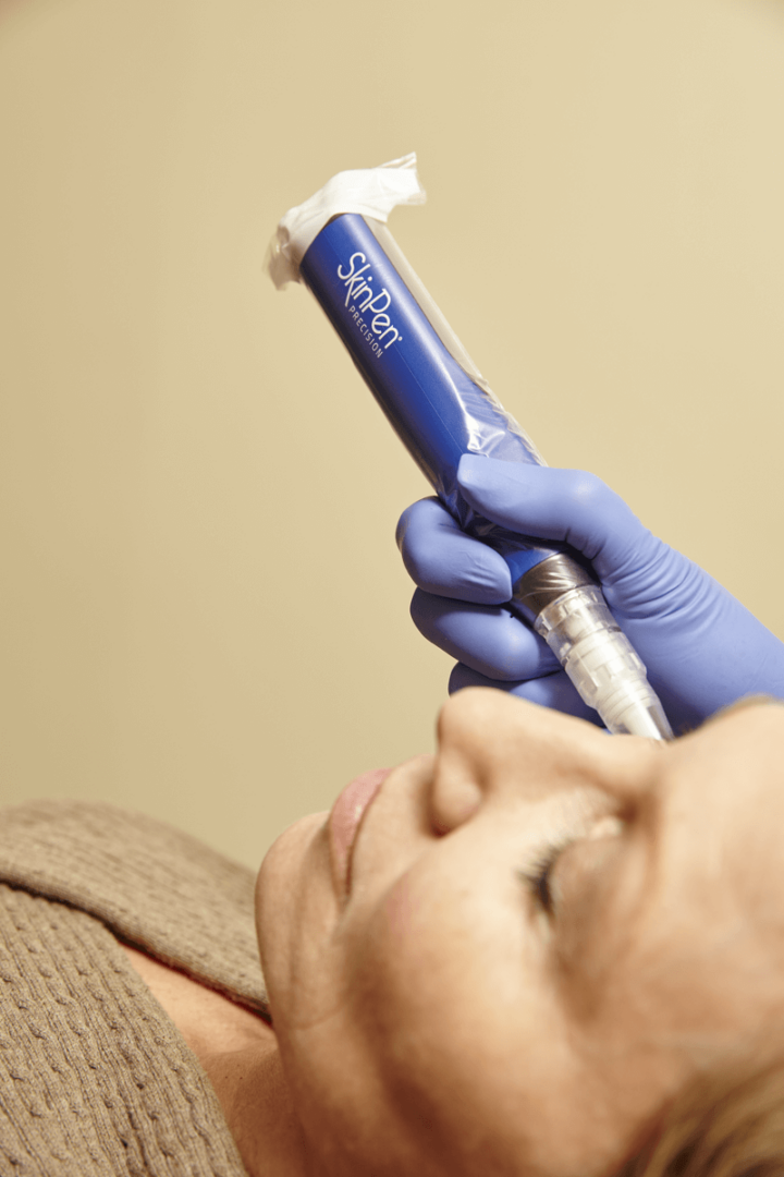 SKINPEN MICRONEEDLING IN GLENDALE, AZ | Vida Bella Medspa
