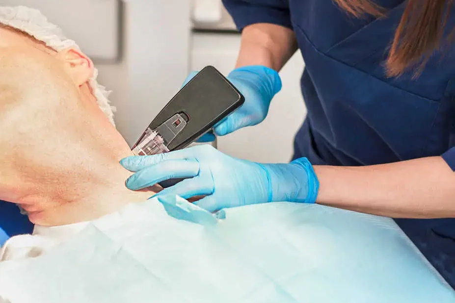 Morpheus 8 Treatment in Glendale, AZ by Vida Bella Med Spa