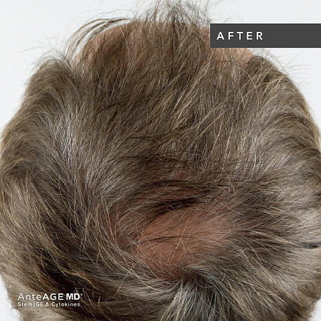 AnteAGE® Hair Restoration Solution