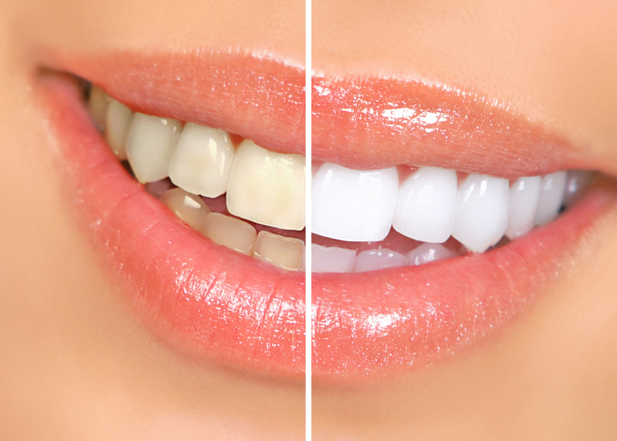 Teeth Whitening Facts, Process, Risk, & Costs