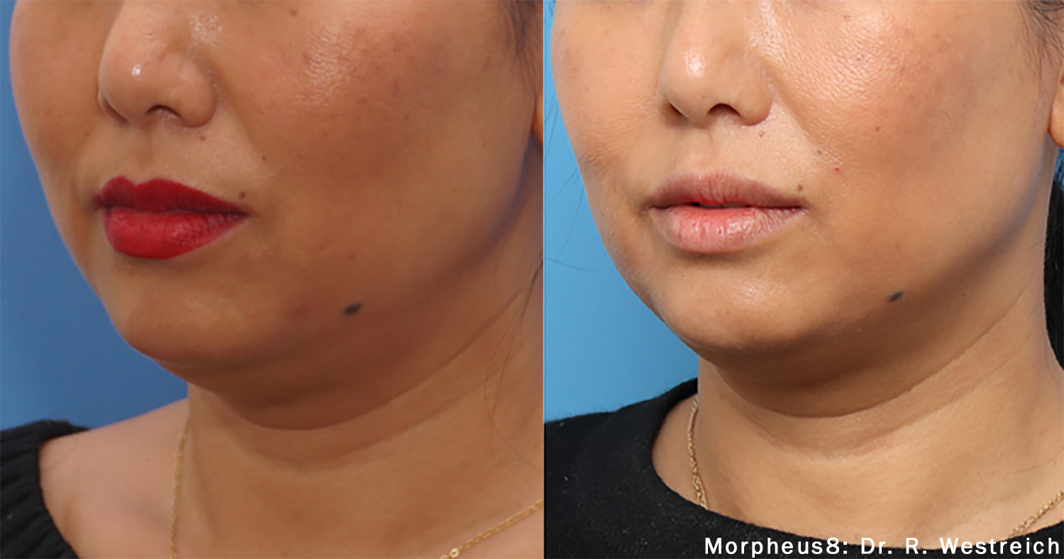 morpheus8-before-after-dr-r-westreich-preview-3