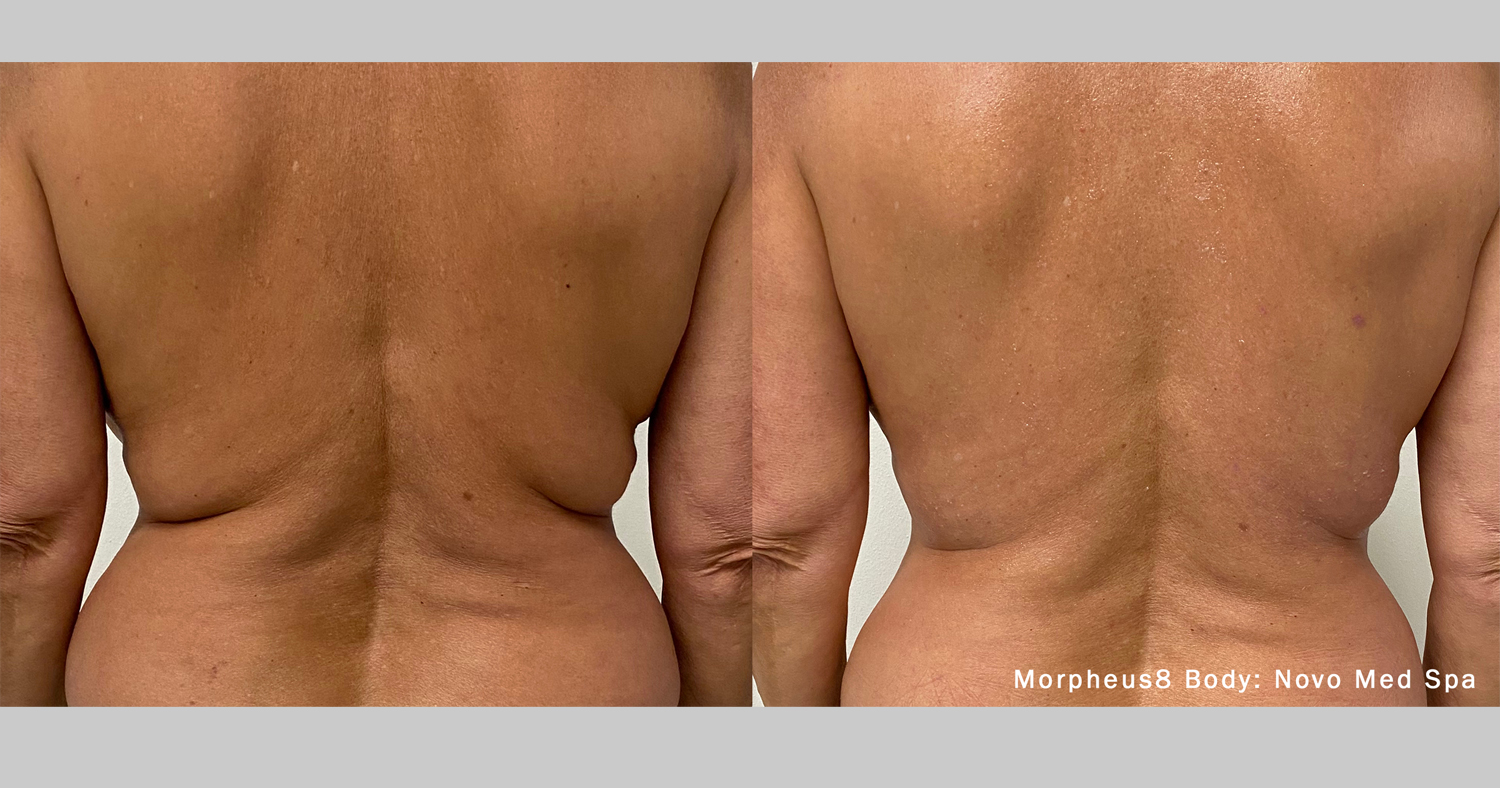 morpheus8-novo-med-spa
